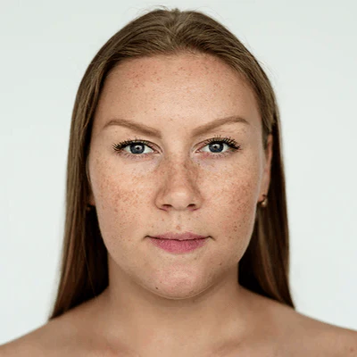 Valoración para Láser para Manchas y Melasma - Procedimientos especializados LASKIN PRO